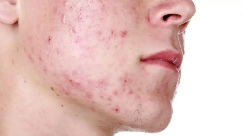 Acné juvenil