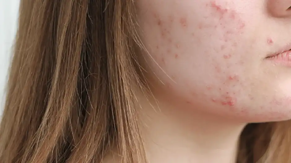 psot tratamiento acné