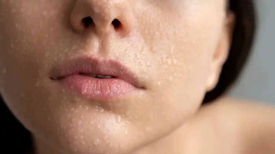 tratamiento sudor con toxina