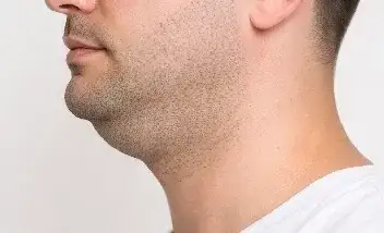 papada por acumulo de grasa localizada