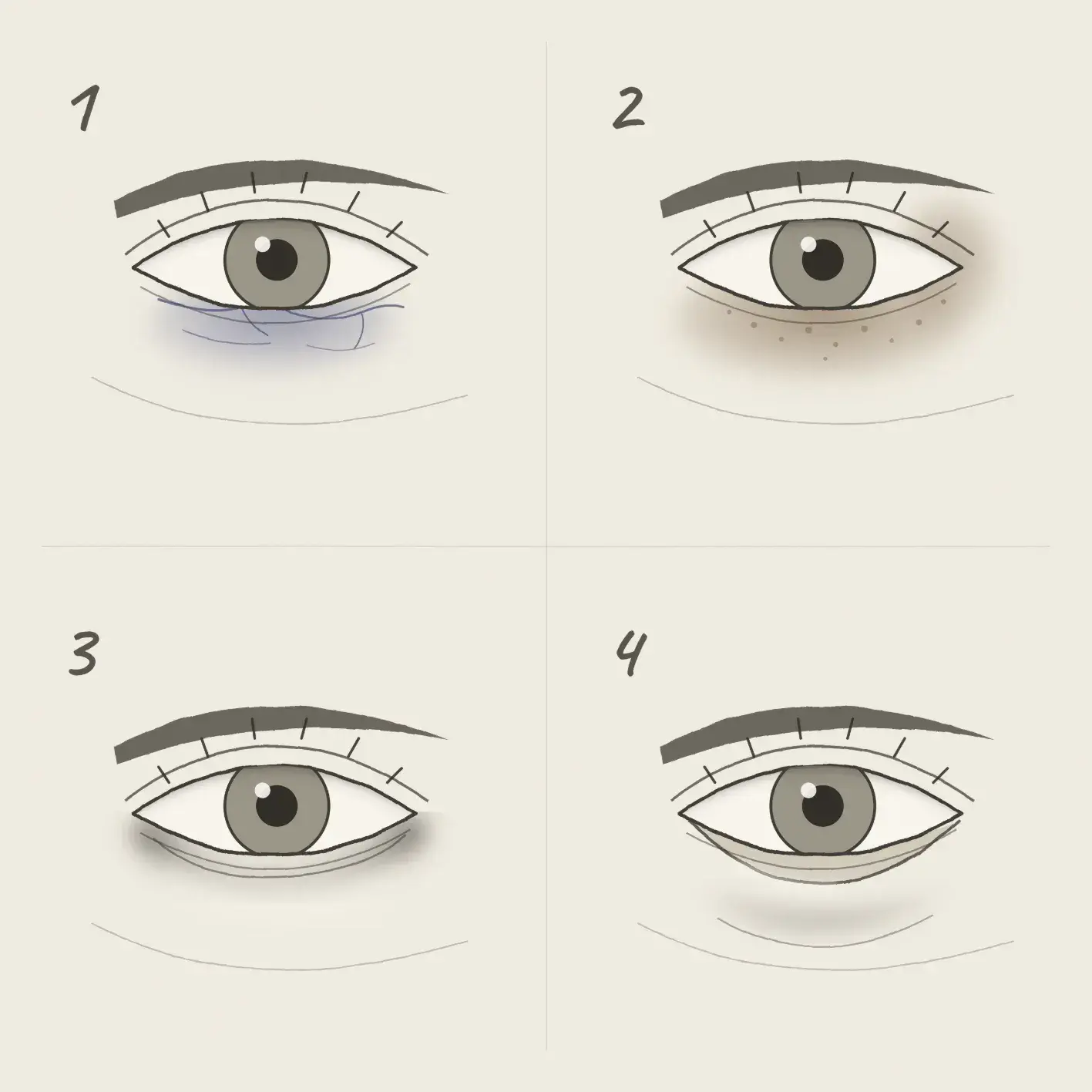 tipos de ojeras