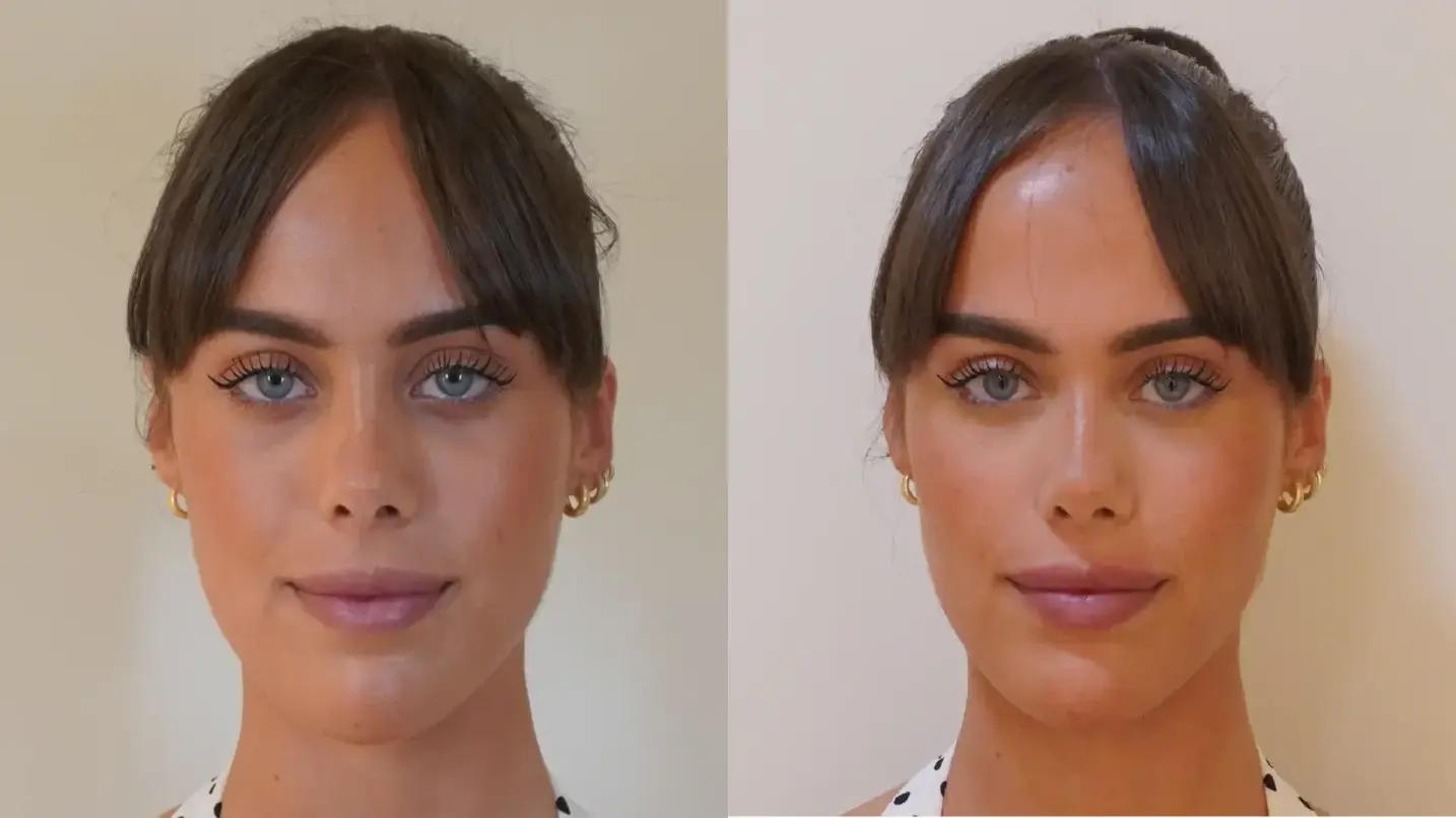 Tratamiento de ojeras: el caso de Andrea
