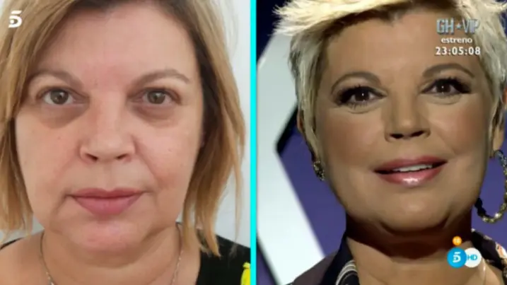 Resultado de terelu campos tras los hilos tensores