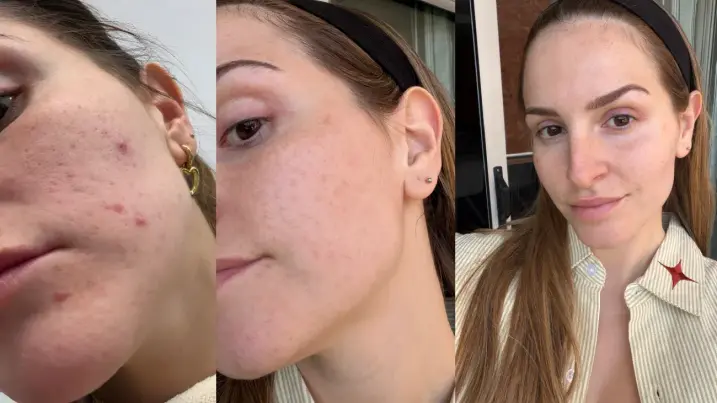 Antes y Después de un tratamiento de laser para manchas de acné