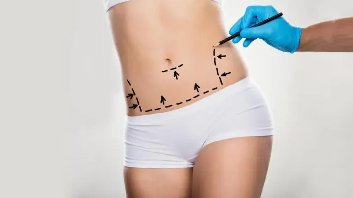 cicatriz abdominoplastia