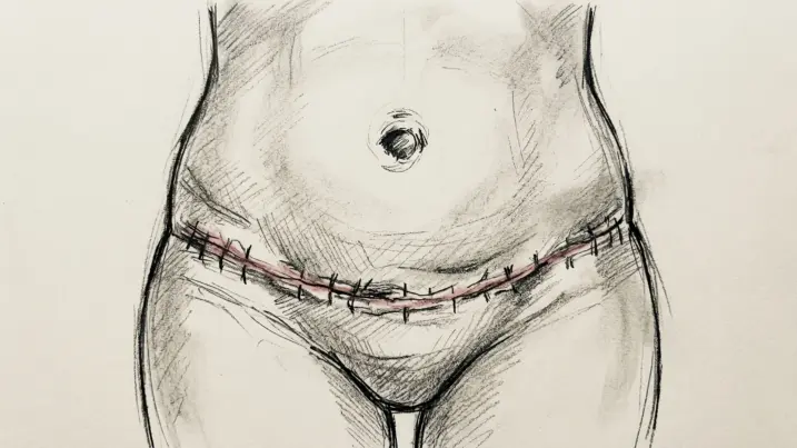 cicatriz 3 semanas abdominoplastia