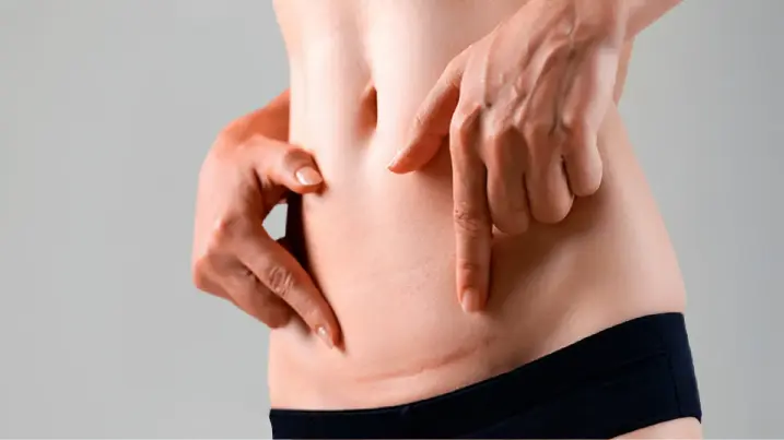 cicatriz de abdominoplastia