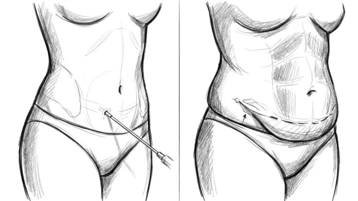 Liposucción VS abdominoplastia