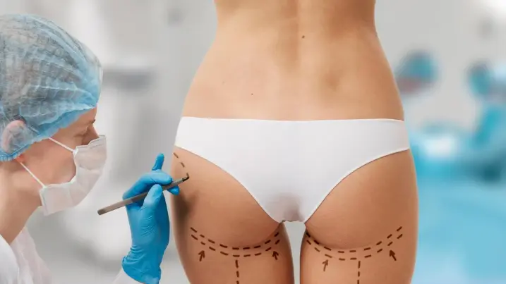 lipotransfrencia de glúteos