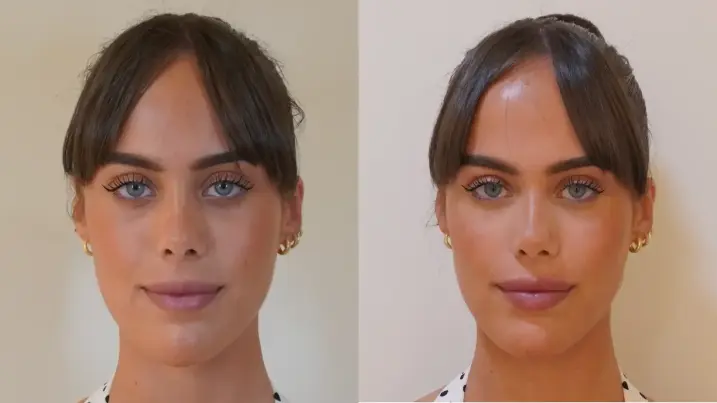 Tratamiento de ojeras: el caso de Andrea