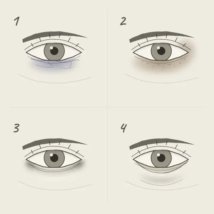 tipos de ojeras