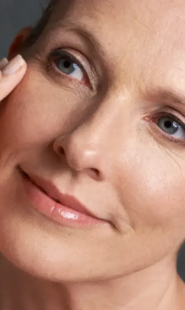 relleno ojeras