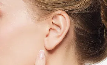 otoplastia