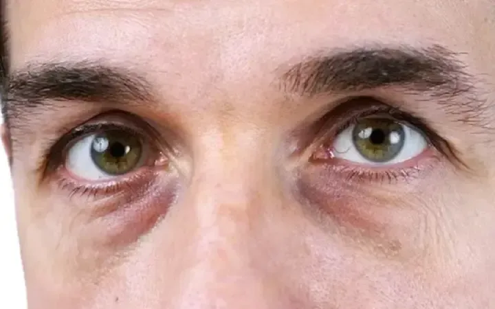 elimina ojeras de manera sencilla