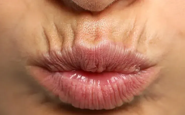 elimina arrugas labio superior