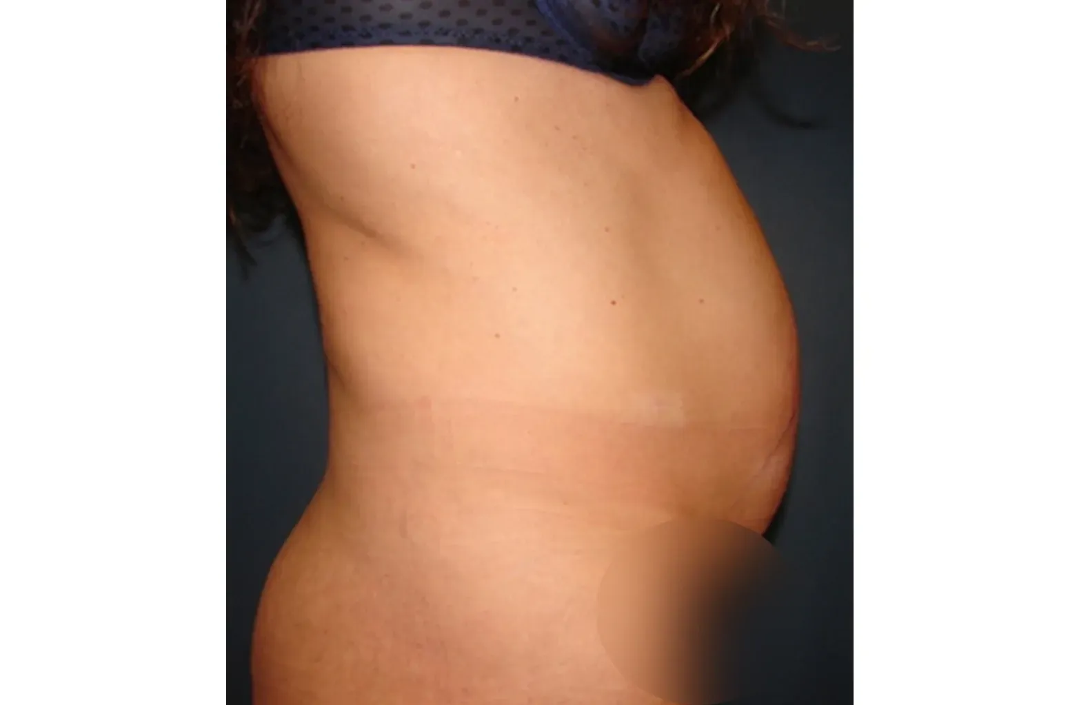 Abdominoplastia carla antes
