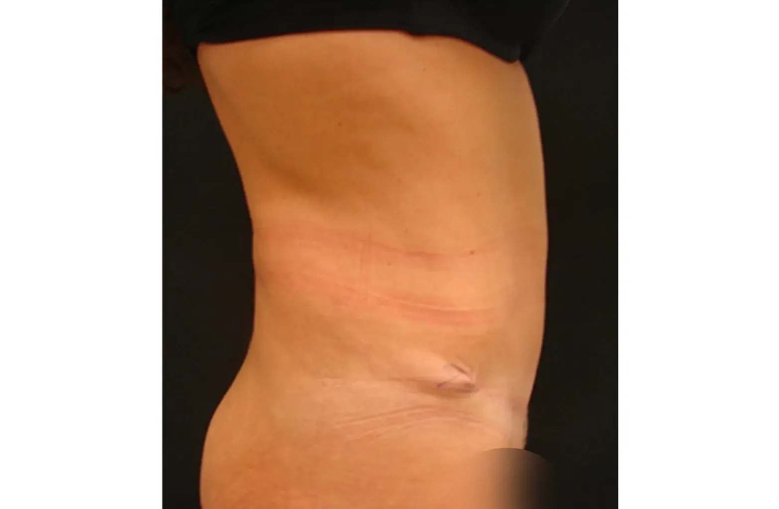 abdominoplastia carla después