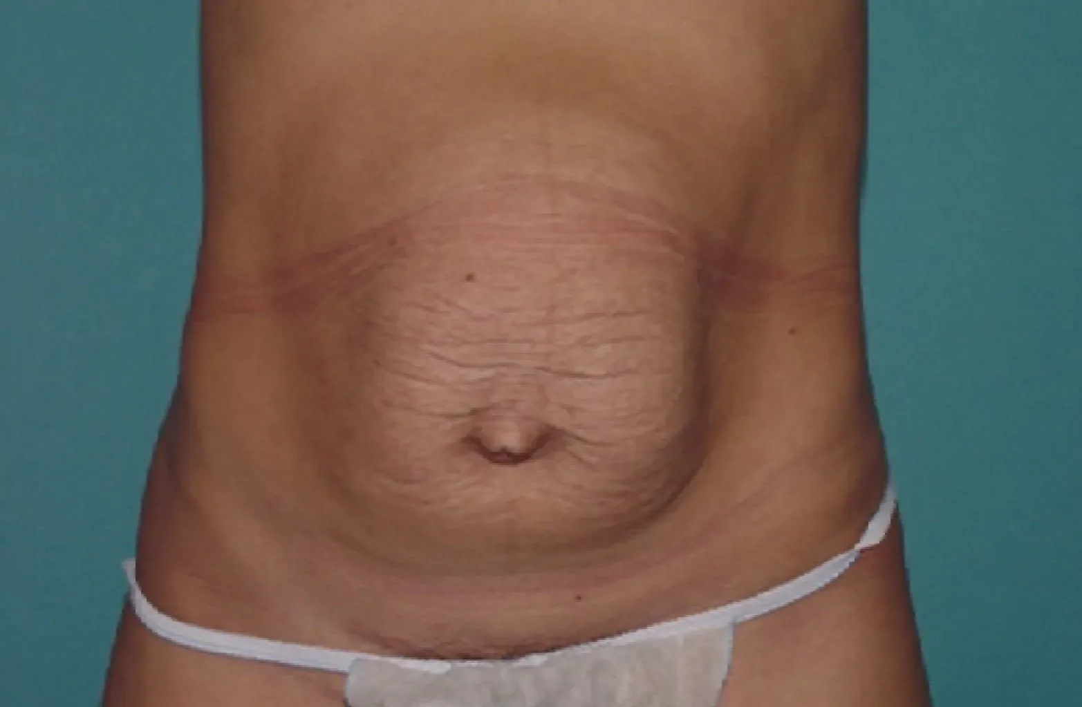 abdominoplastia Laura antes