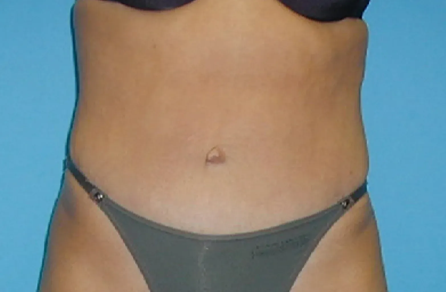 Abdominopalstia laura después