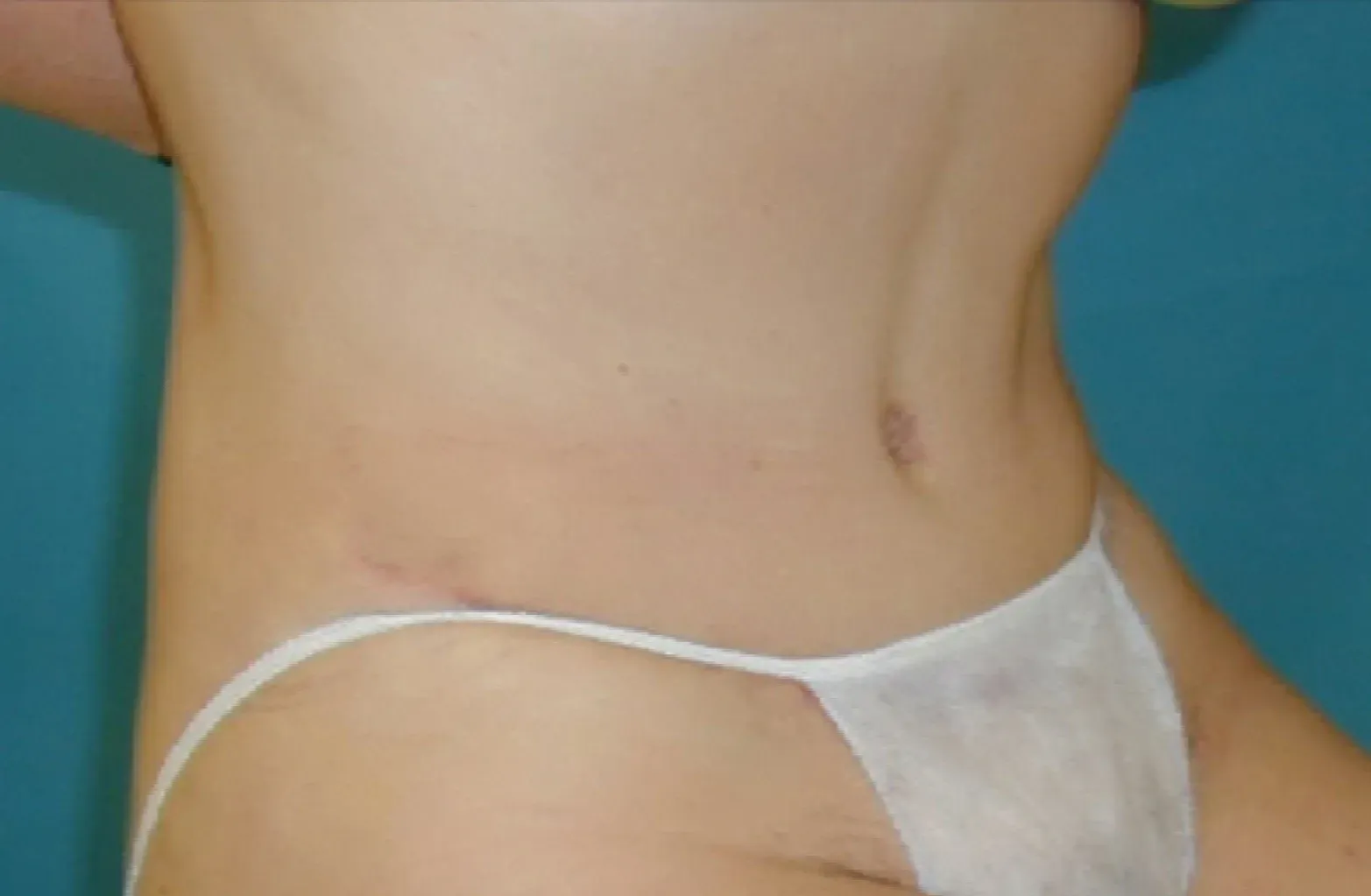 abdominoplastia maria despues