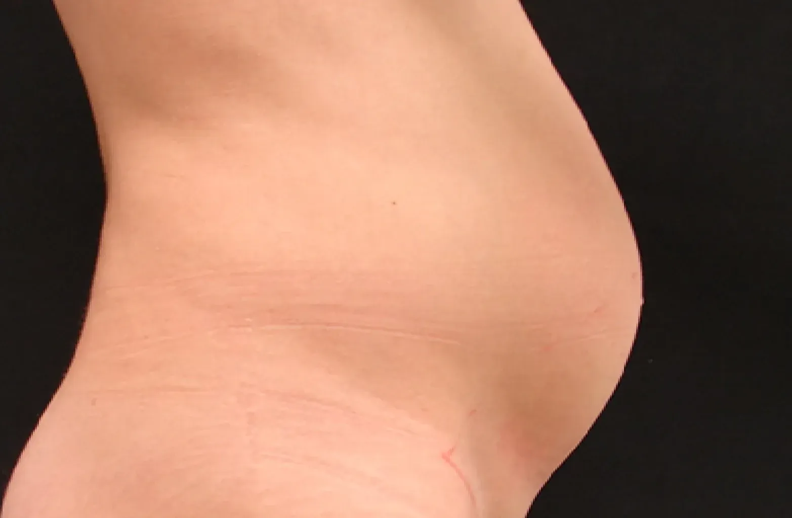 abdominoplastia antes