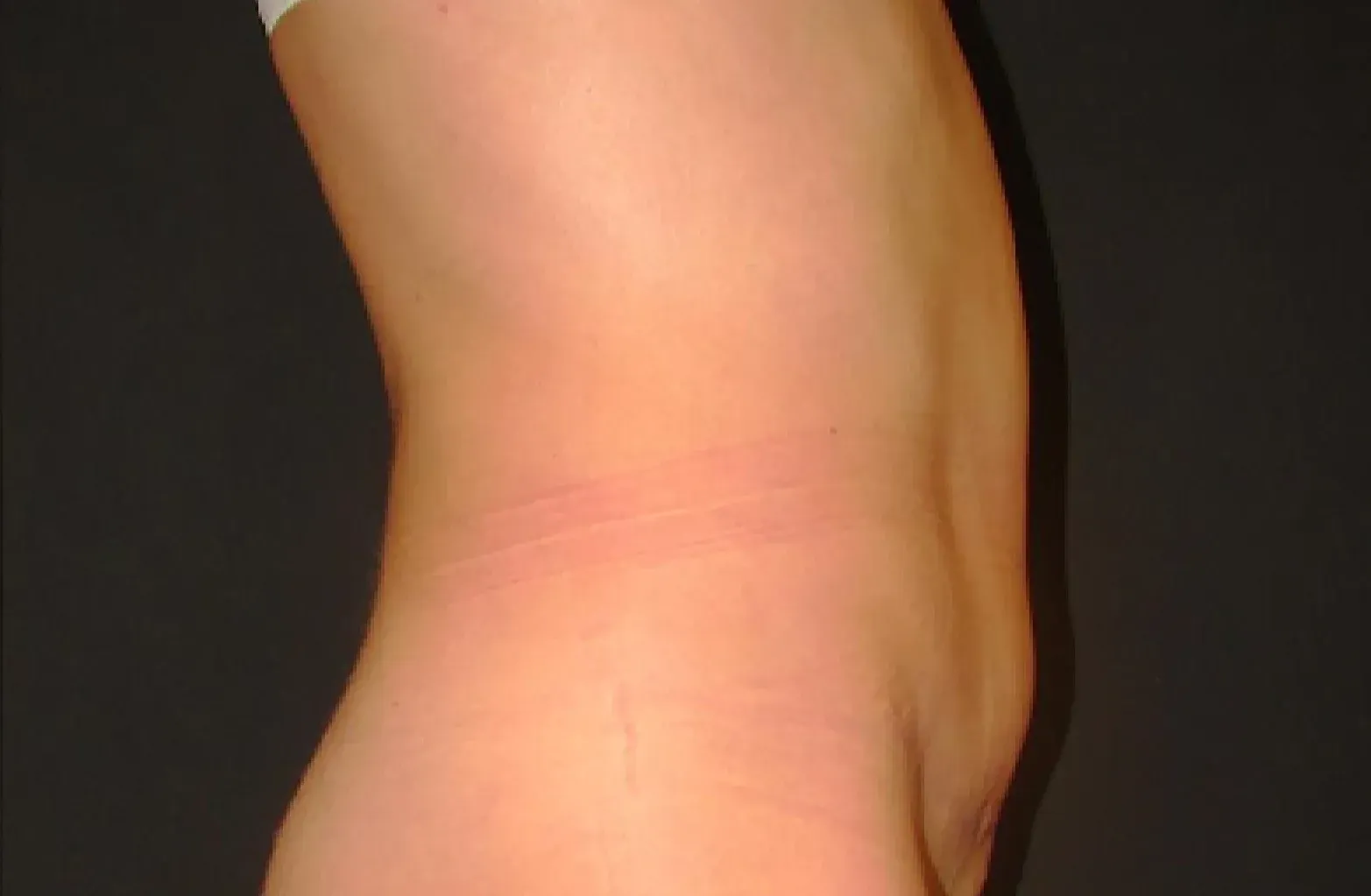 Abdominoplastia después