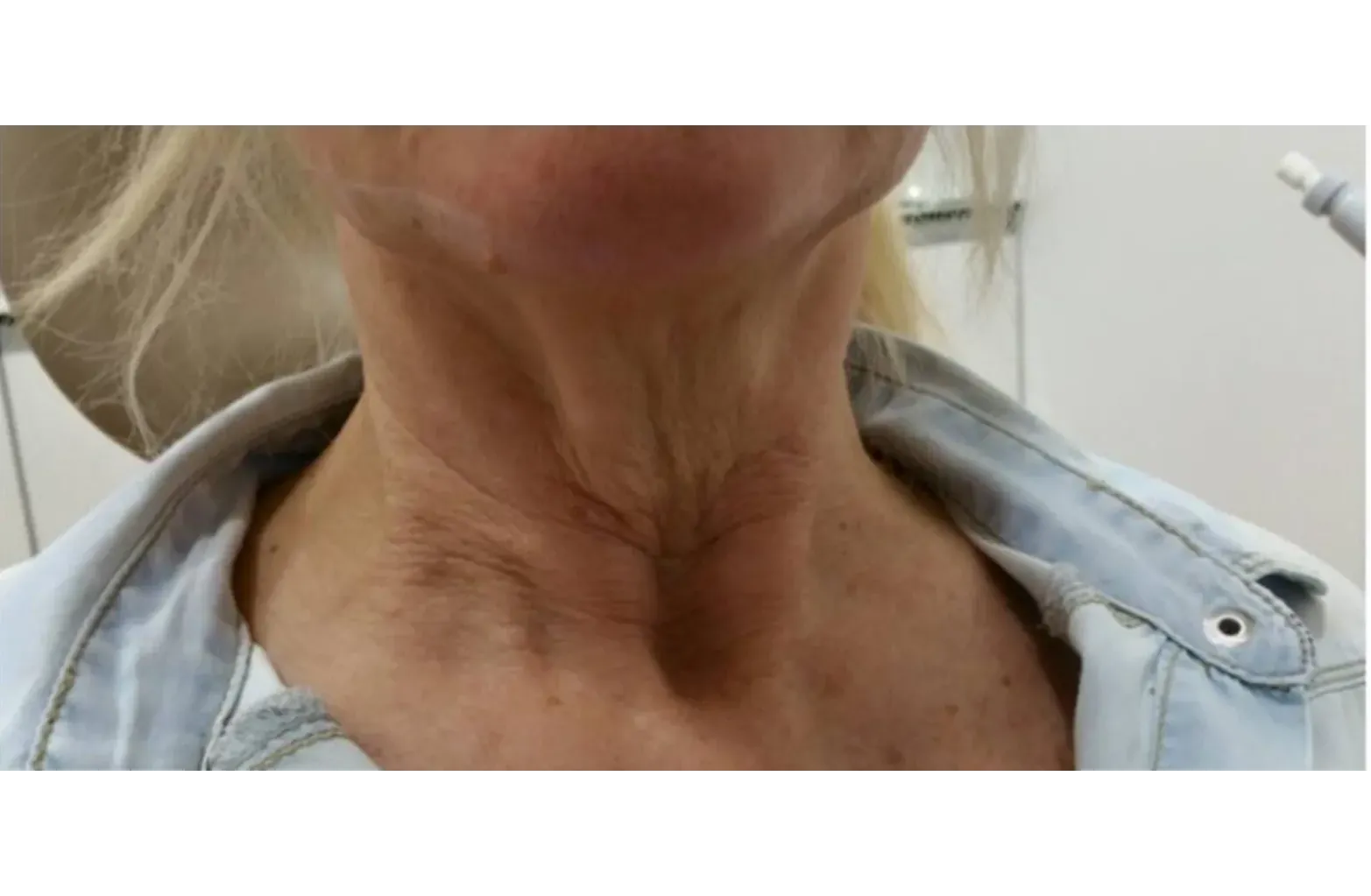 Cuello antes de ser operado de lifting de cuello