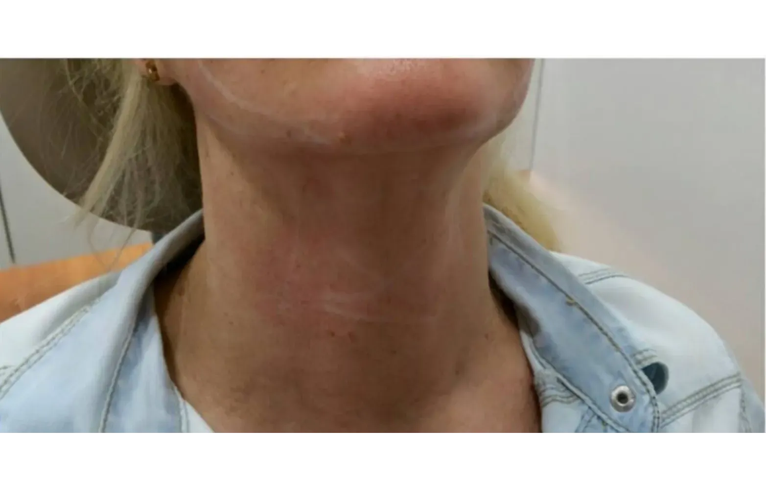 Cuello después de ser operado de lifting de cuello