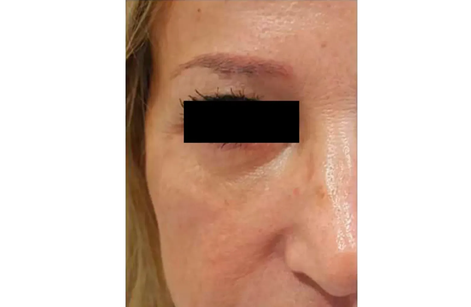 después eliminar ojeras