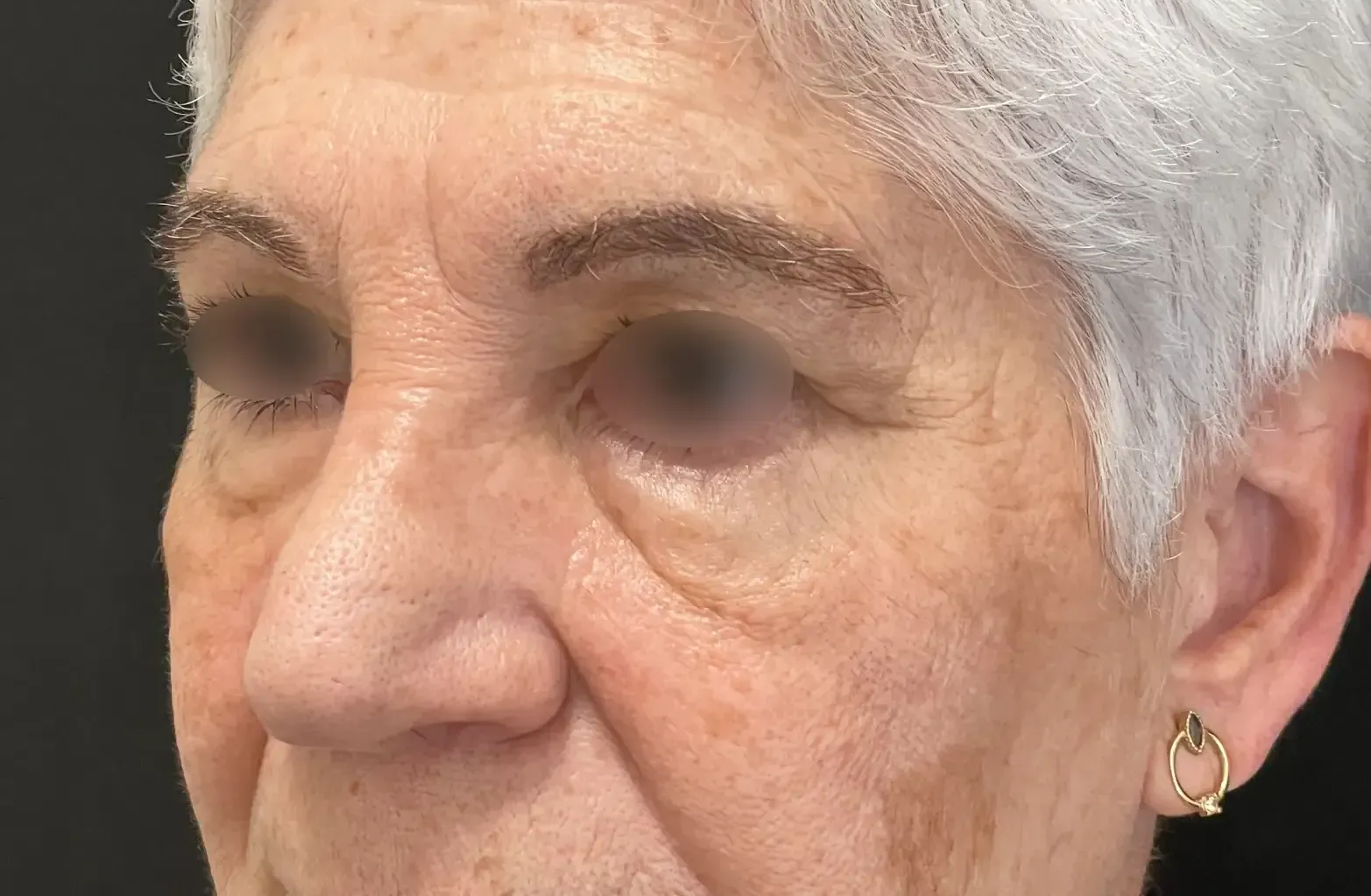 elevación de cejas antes