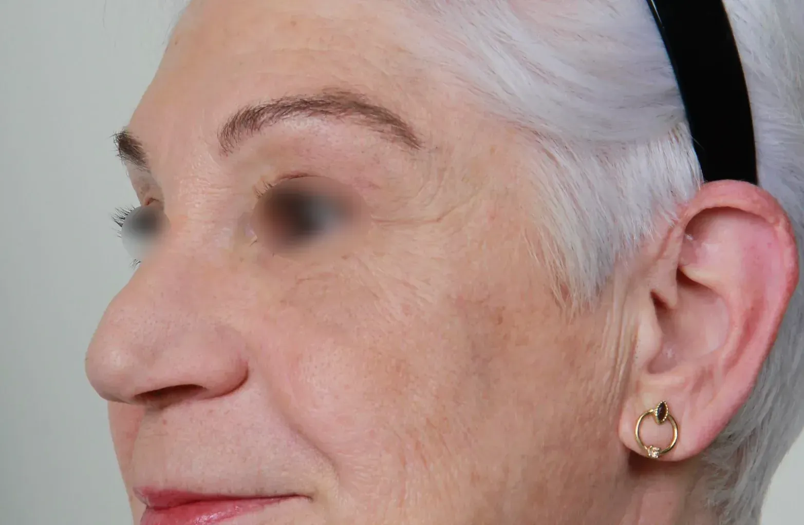 elevación de cejas después