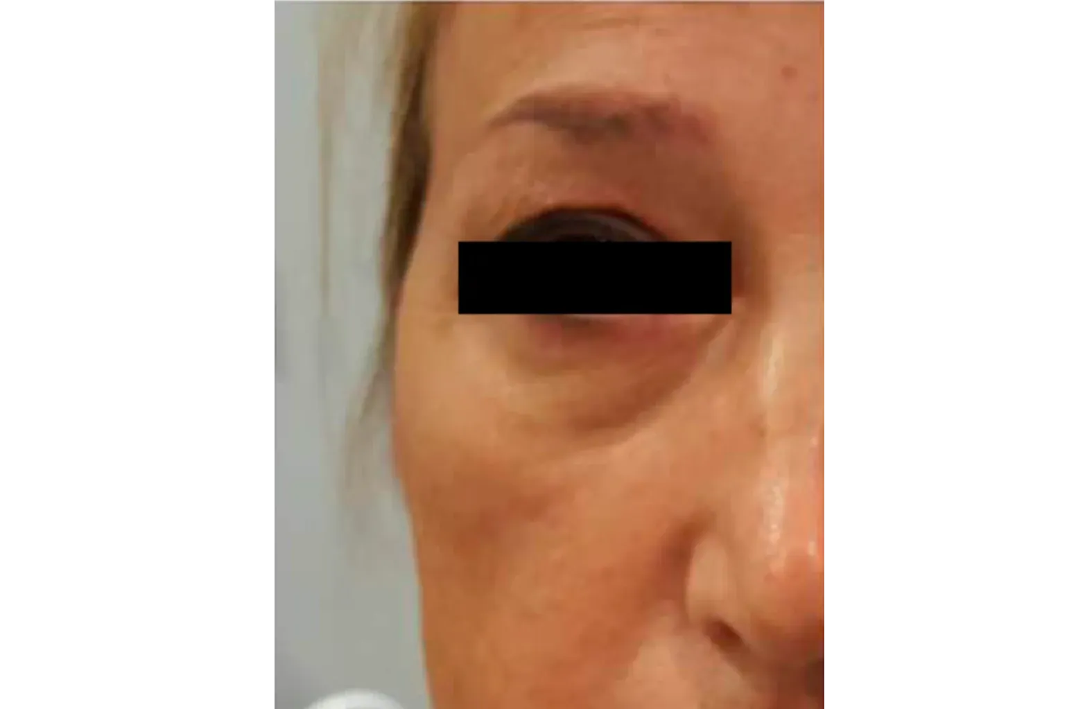 antes eliminar ojeras