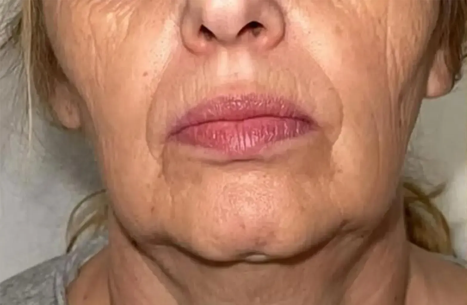Lifting facial antes