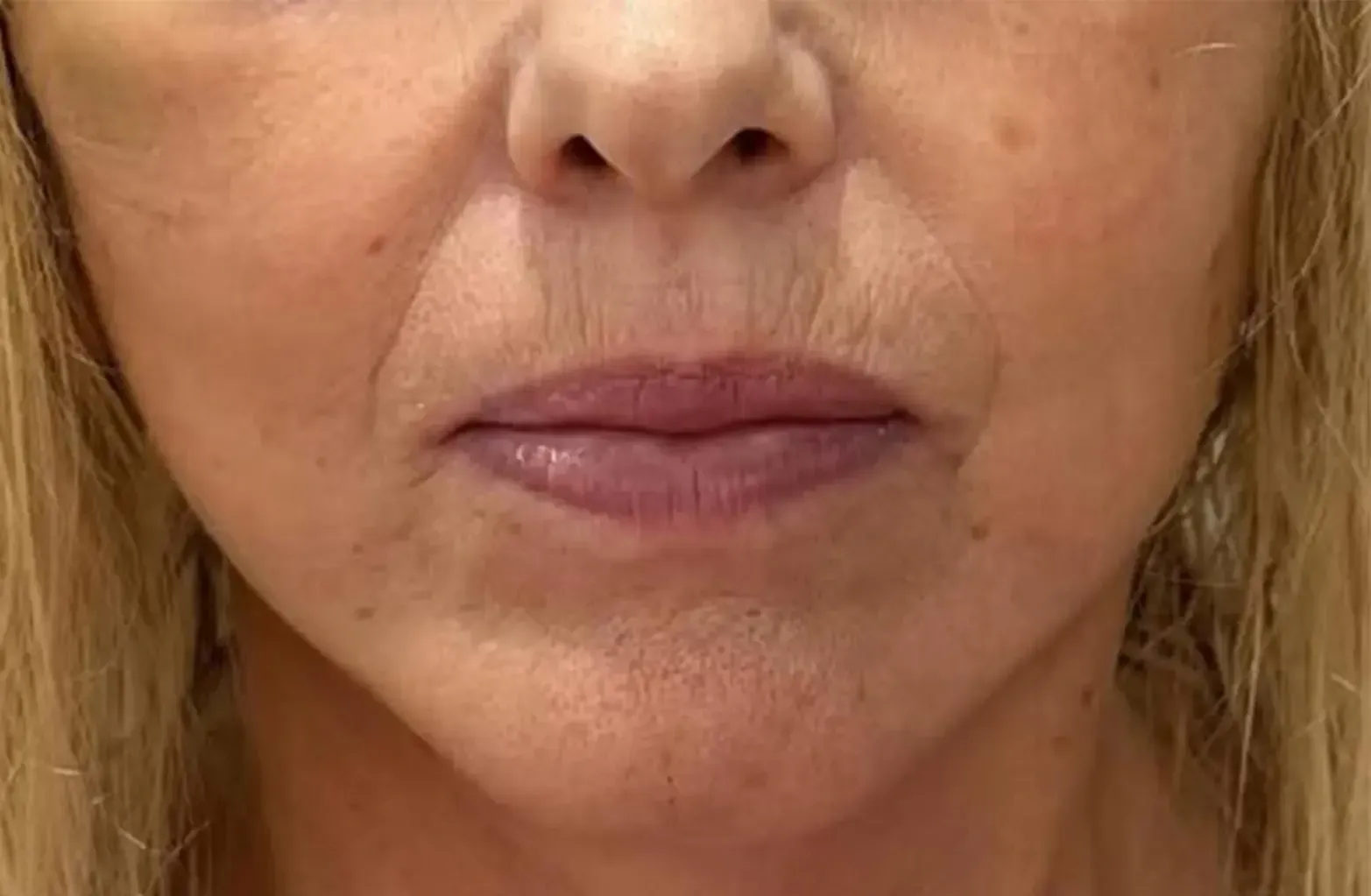 Lifting facial después