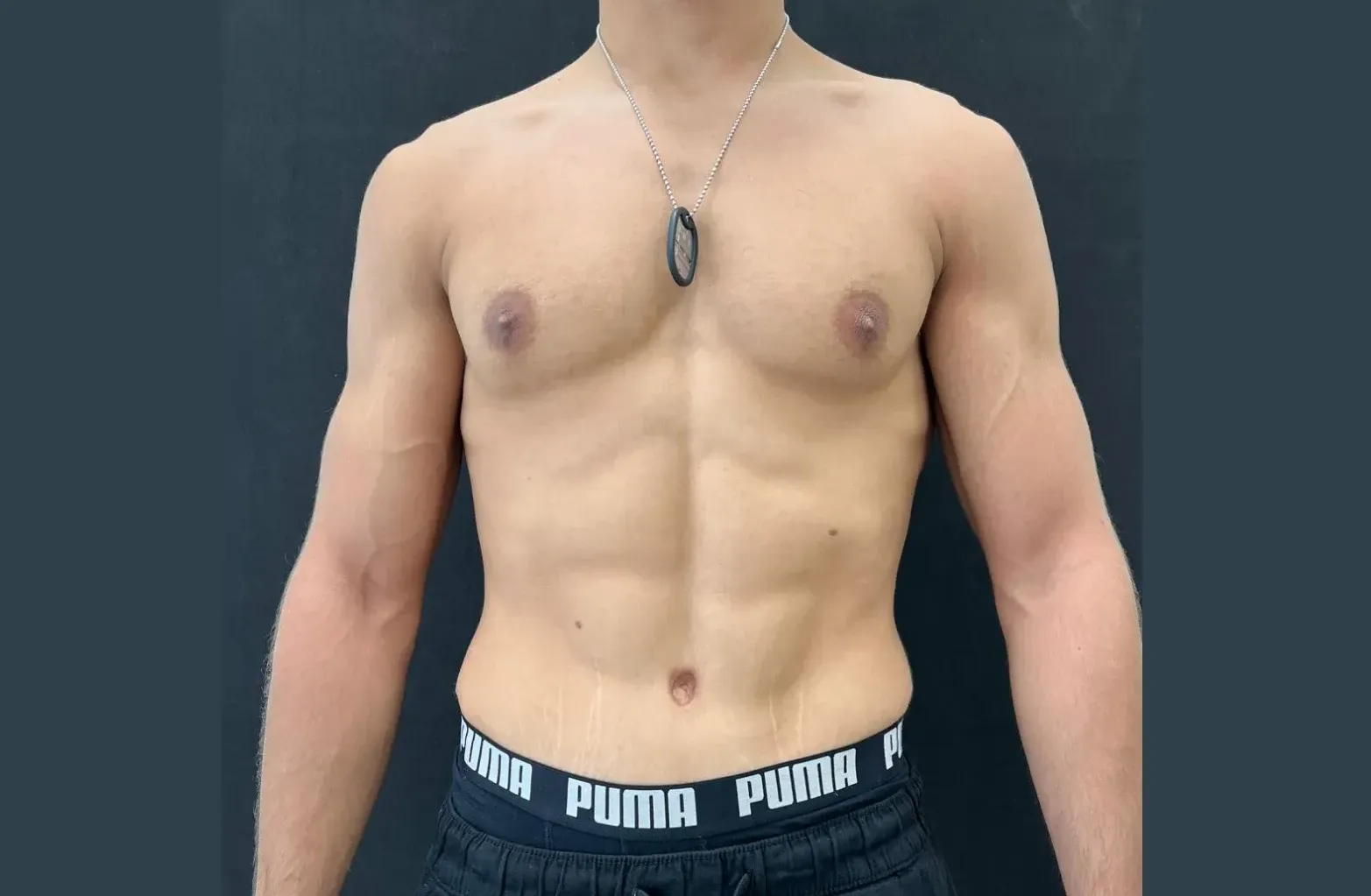 liposucción hd despues
