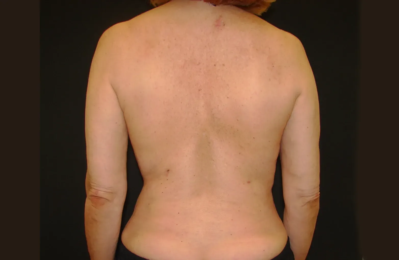 liposucción de espalda después