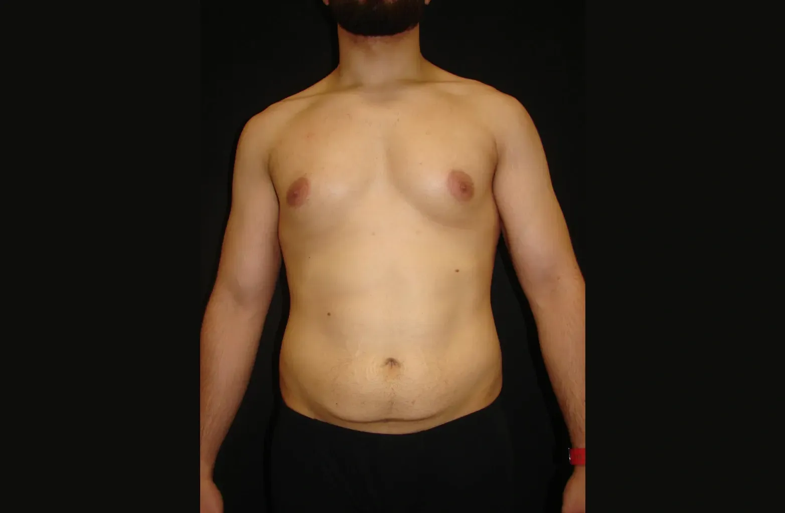 Liposucción HD antes