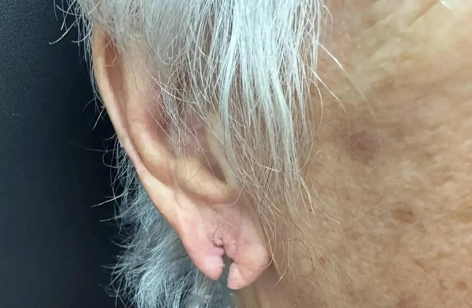 Lobuloplastia de carmen antes