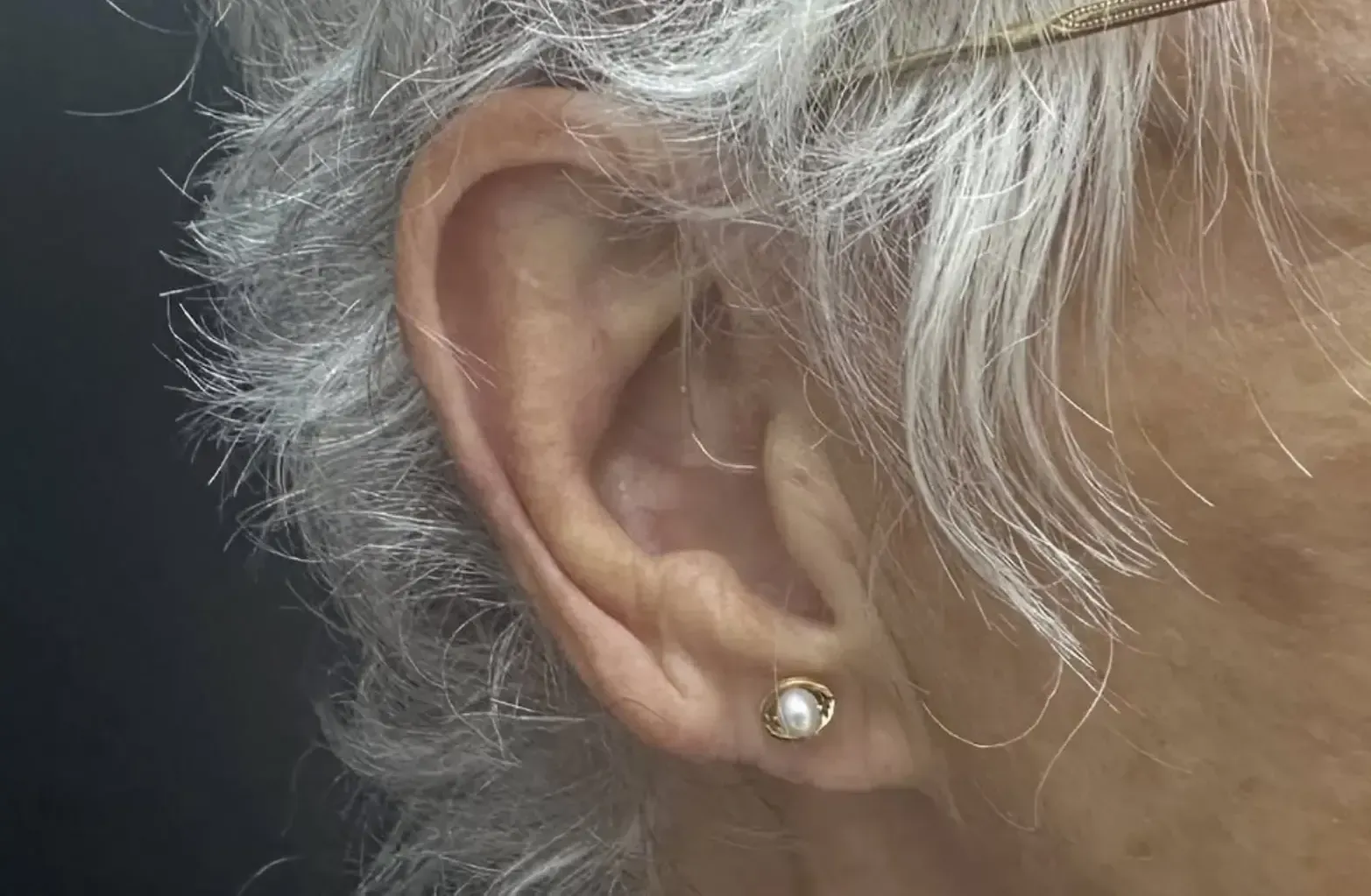 lobuloplastia de carmen después