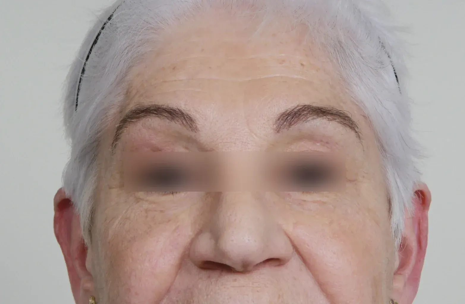 Antes: Brow lift