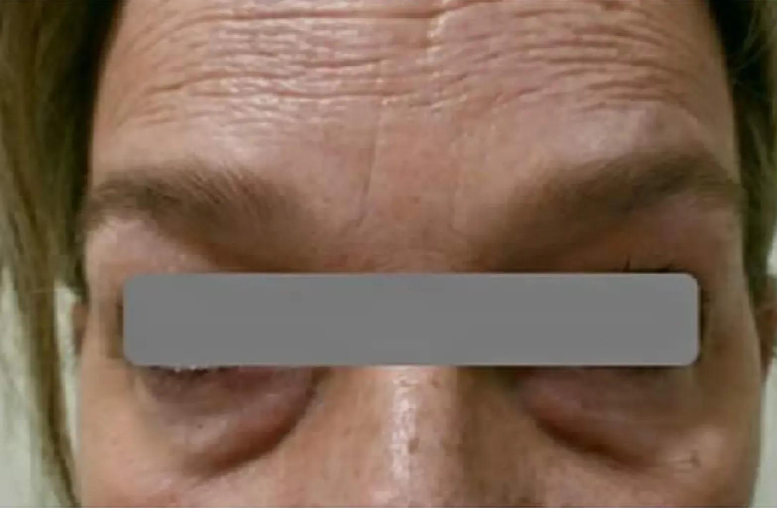 Eliminar ojeras antes