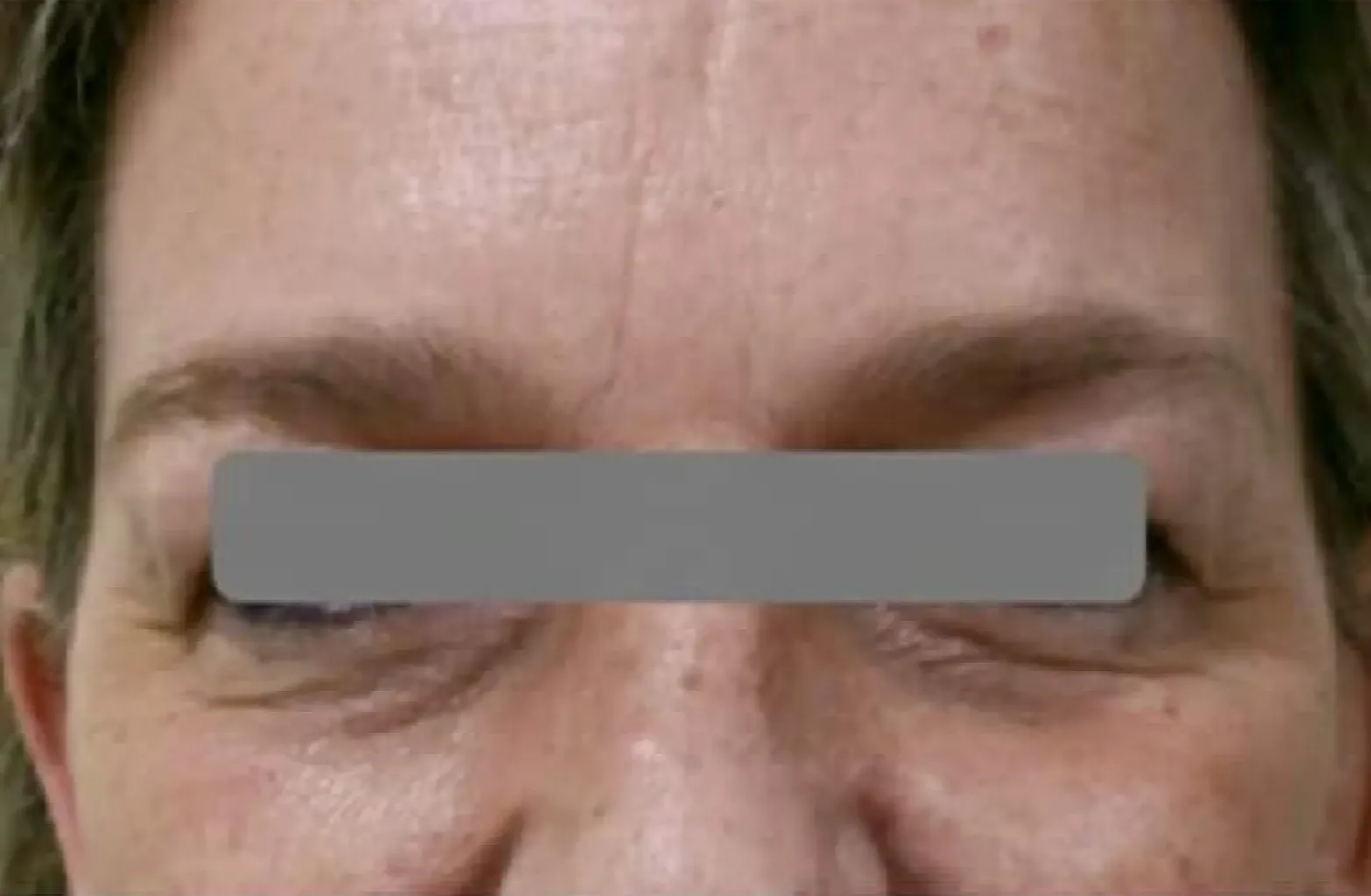 quitar ojeras después