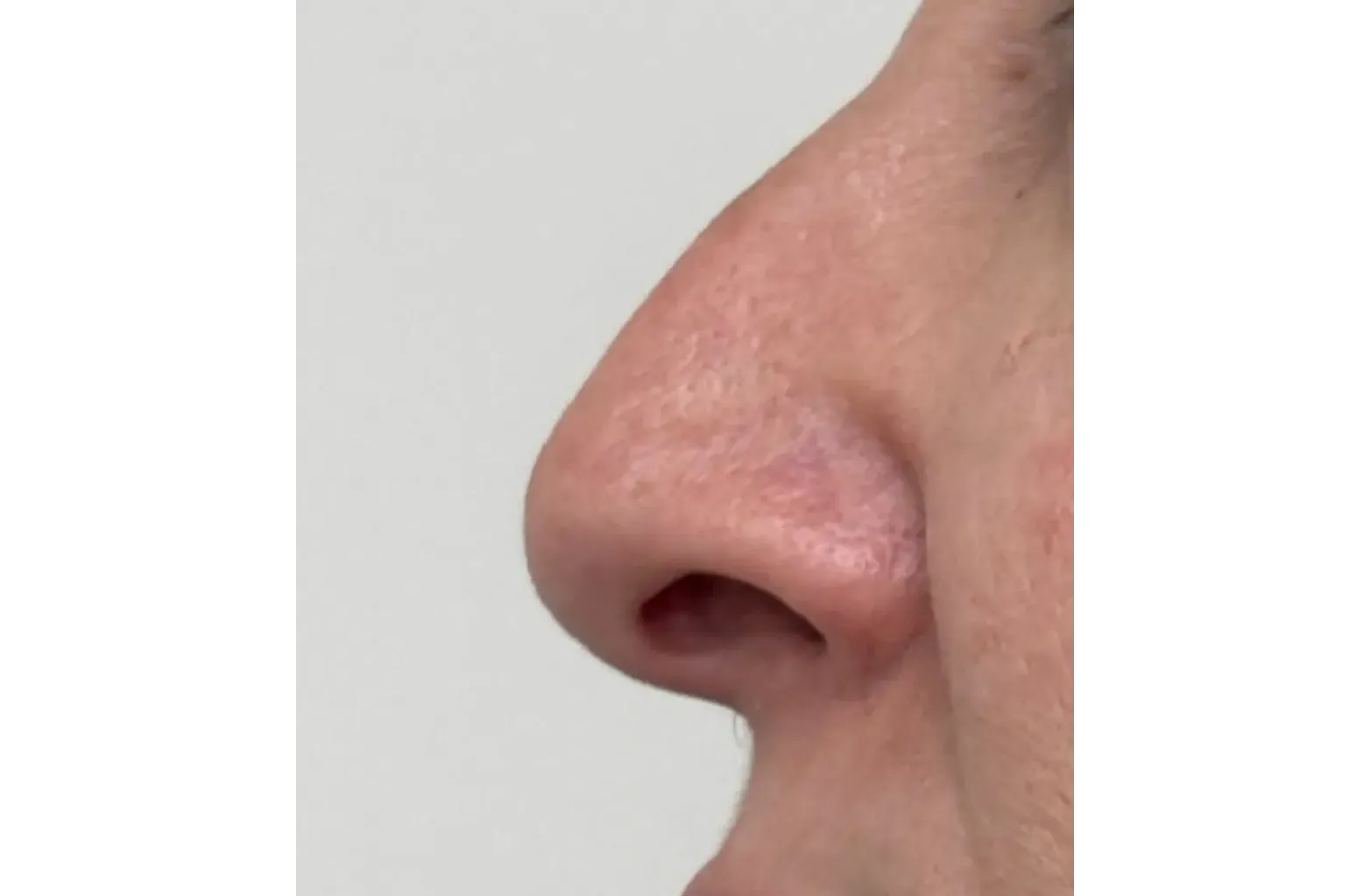 Después: Rhinoplasty