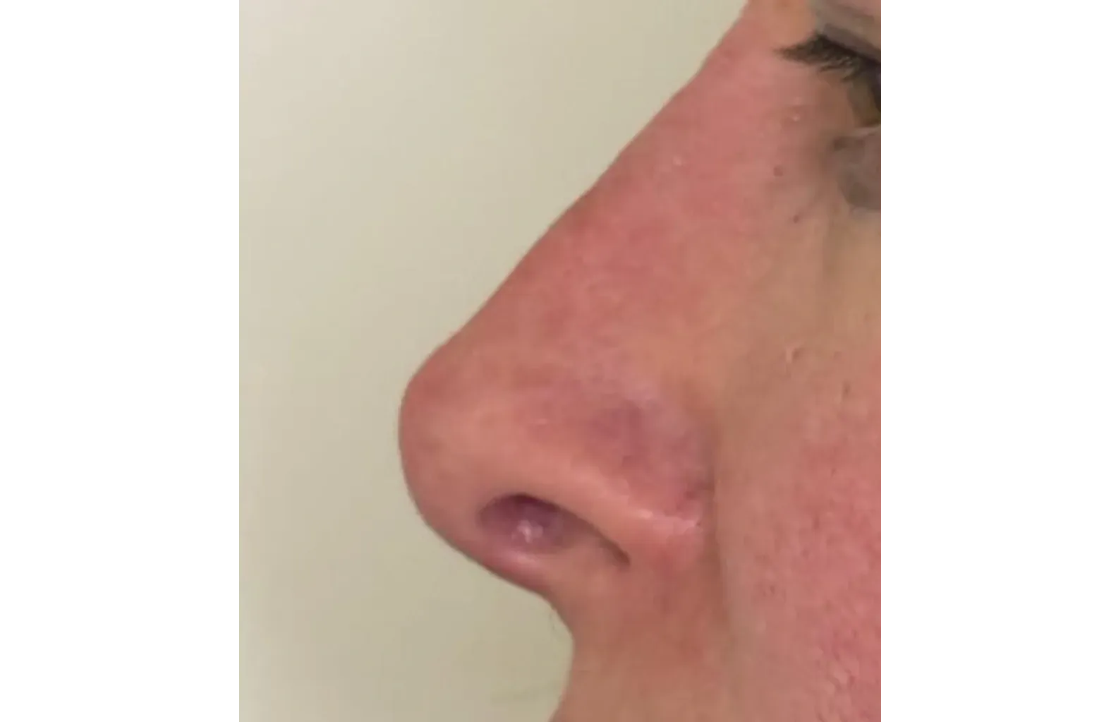 Antes: Rhinoplasty