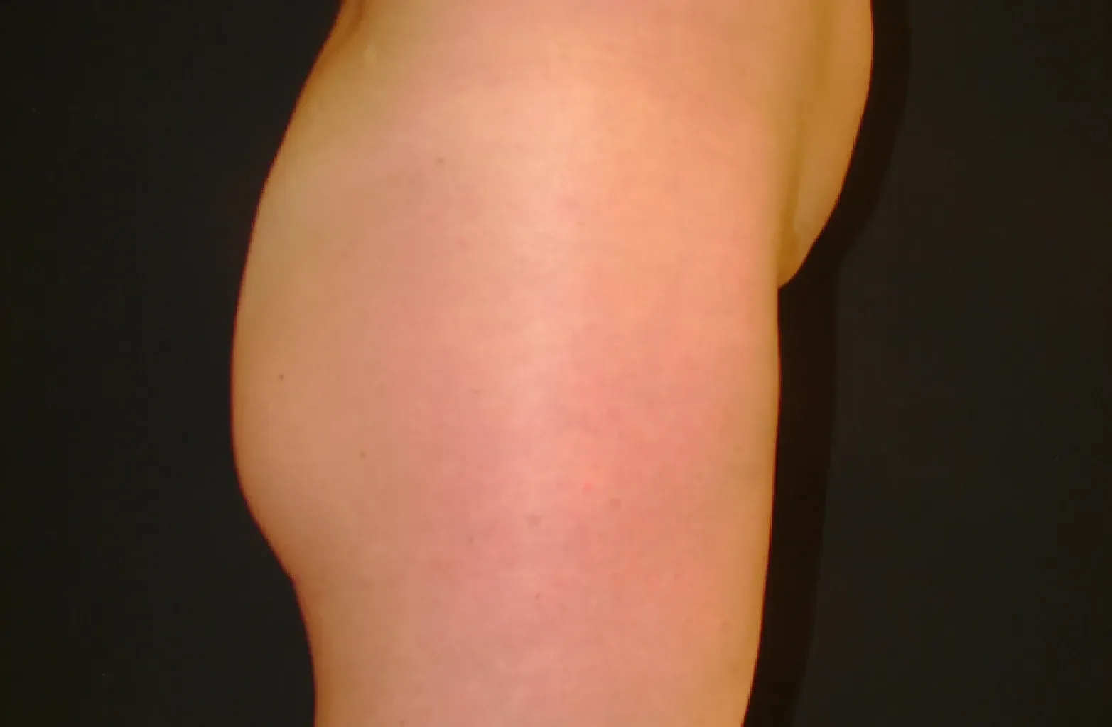 aumento de gluteos antes