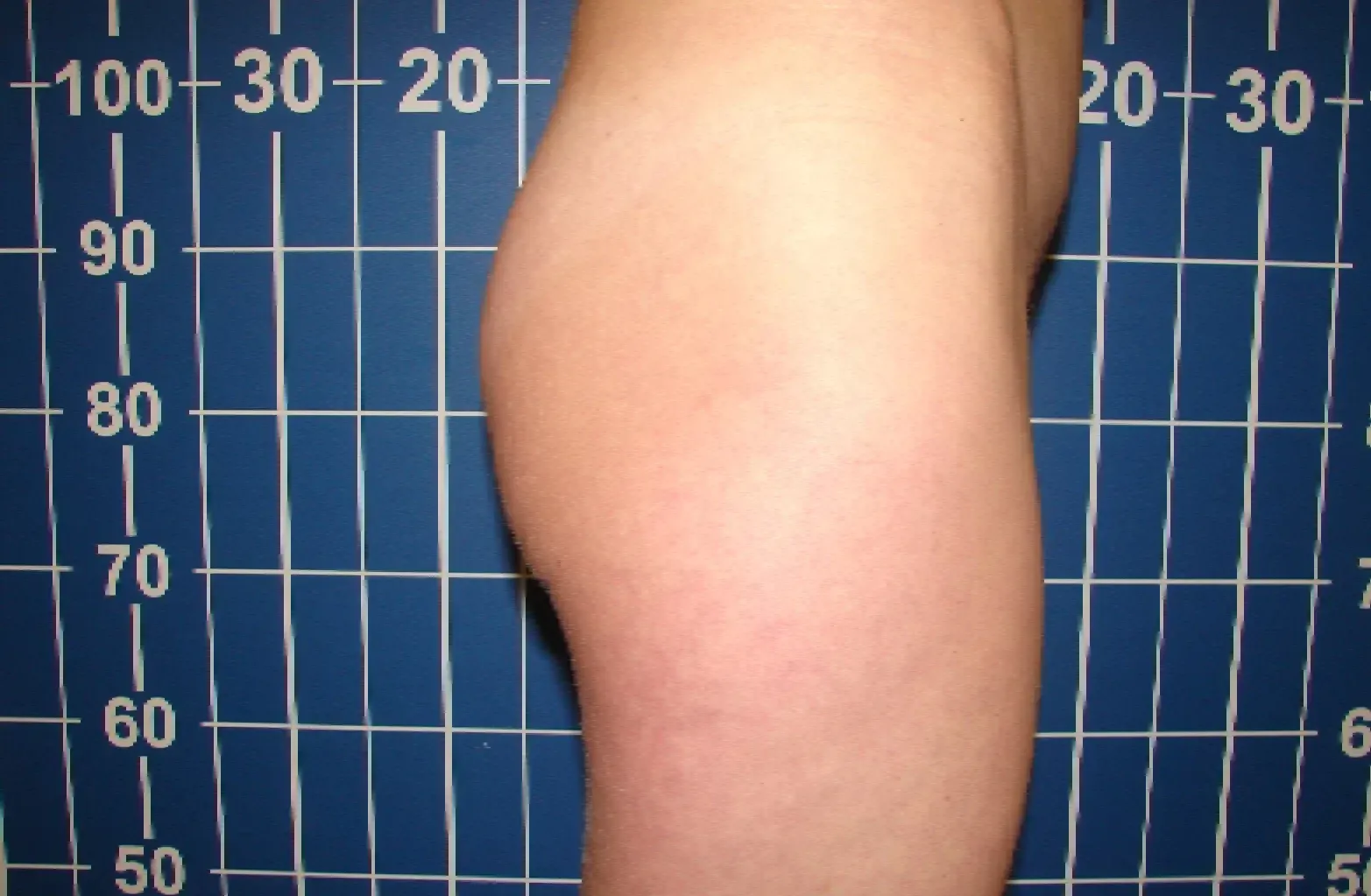 virgina aumento por lipotransferencia antes