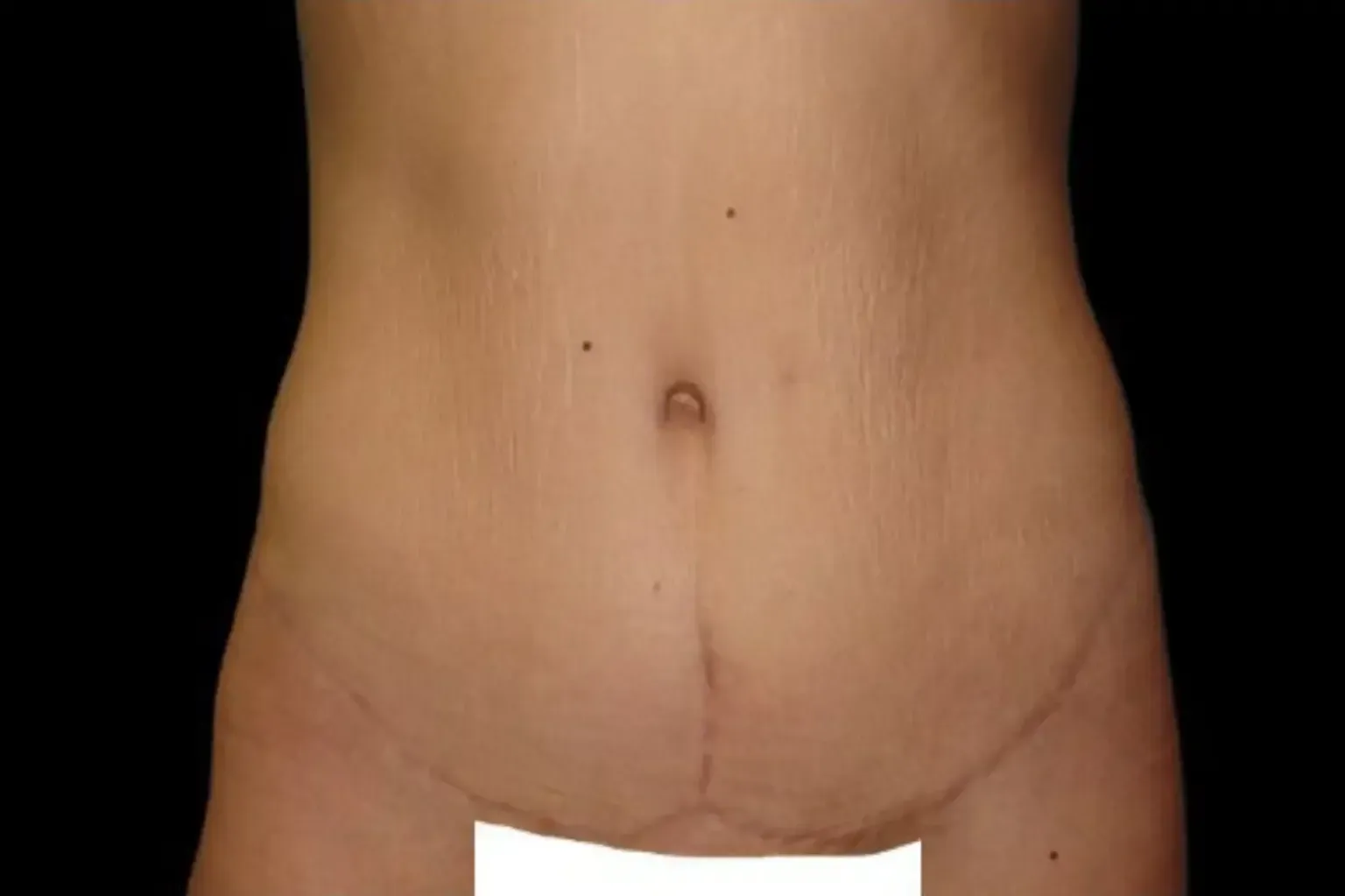 El resultado tras una cirugía de abdominoplastia