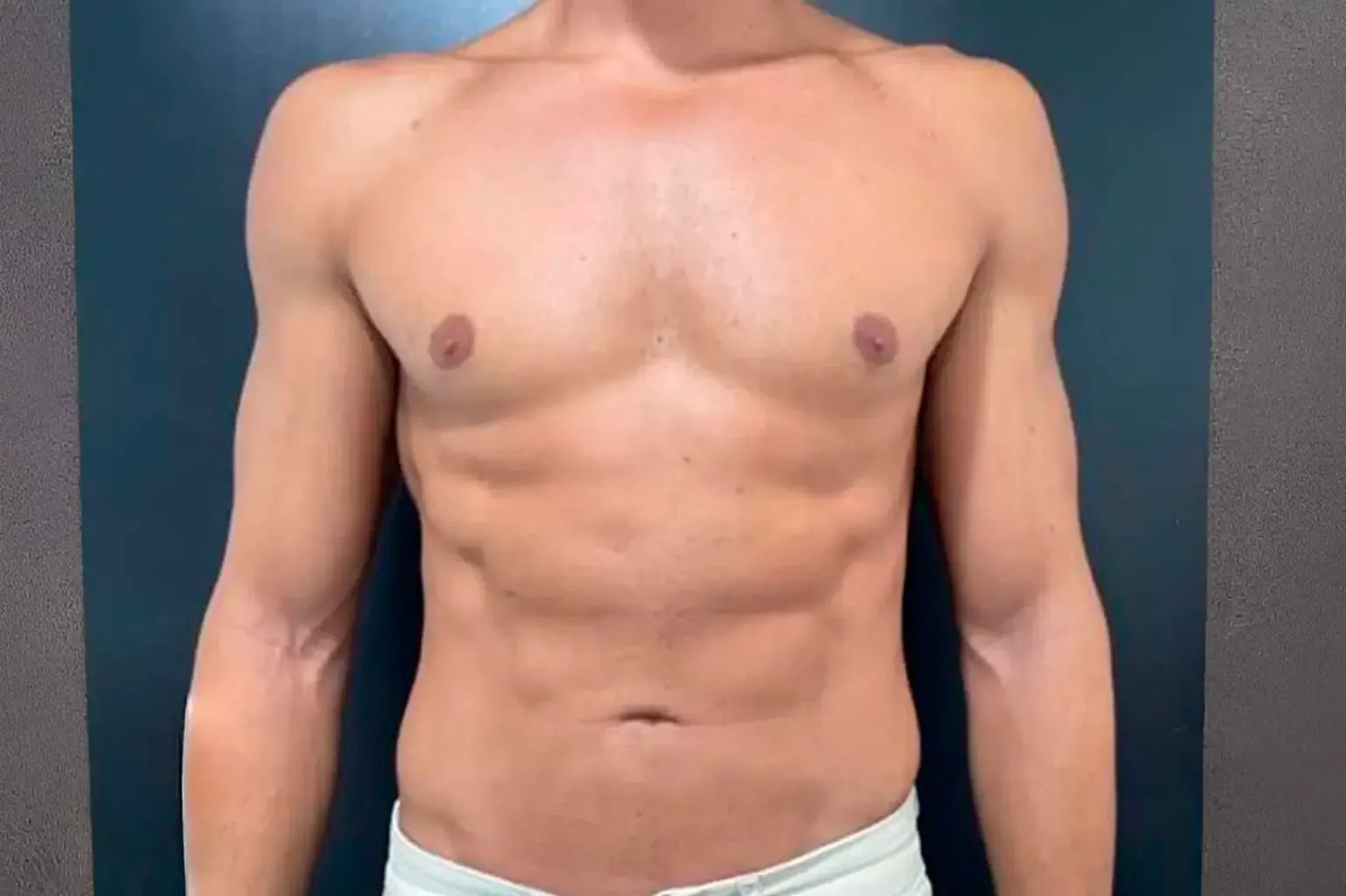 Cirugía de liposucción de abdomen HD