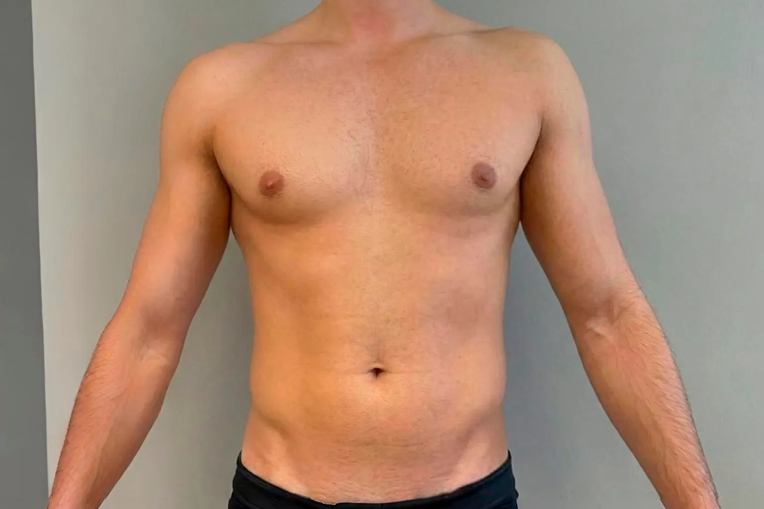 Cirugía de liposucción de abdomen HD