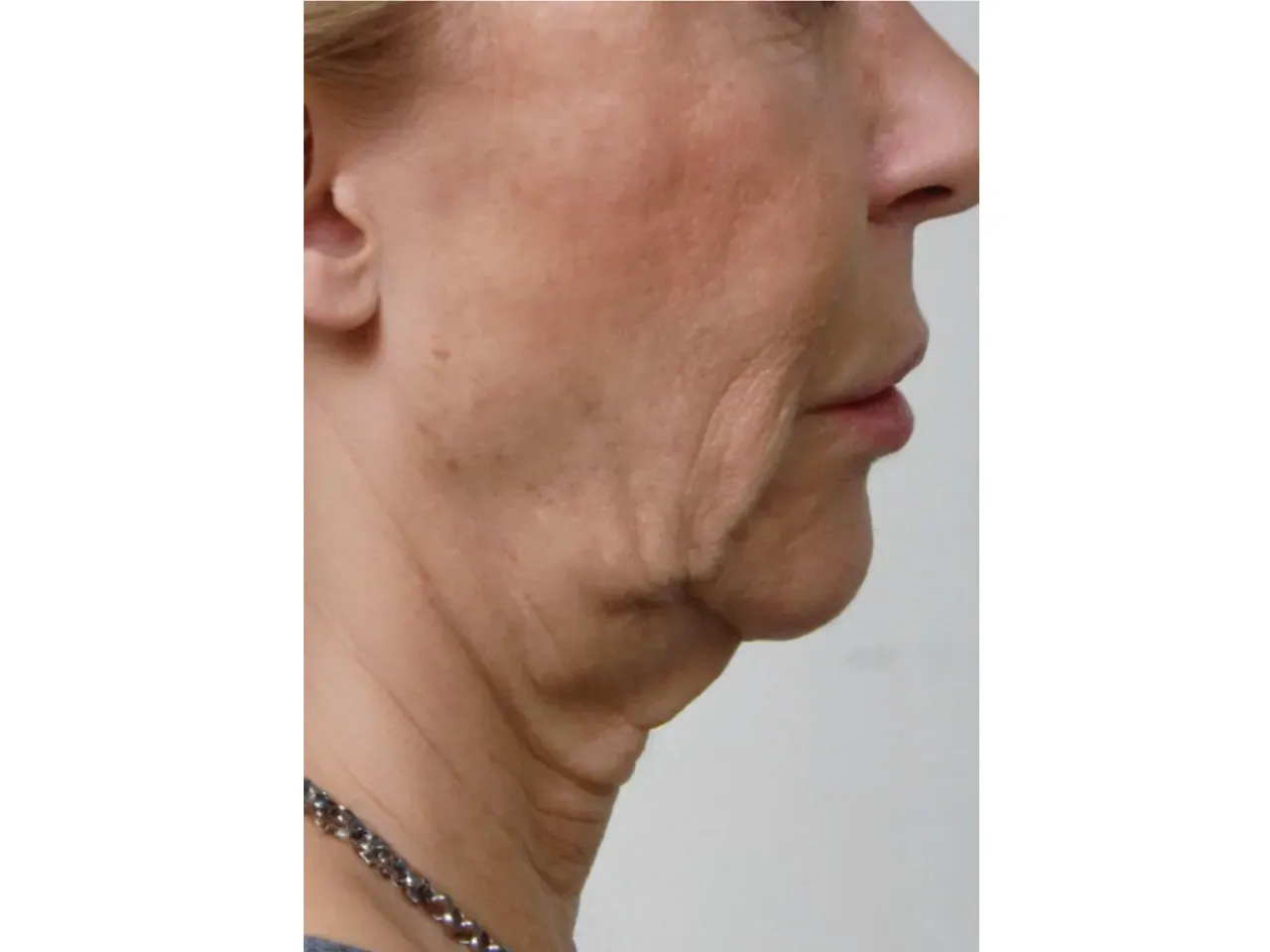 Después: Double chin liposuction + Facelift ✨